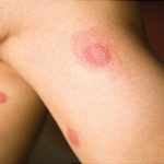 Multidrug-resistant Gram-Negative Skin and Soft Tissue Infections