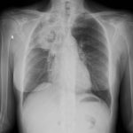 aspergillosis